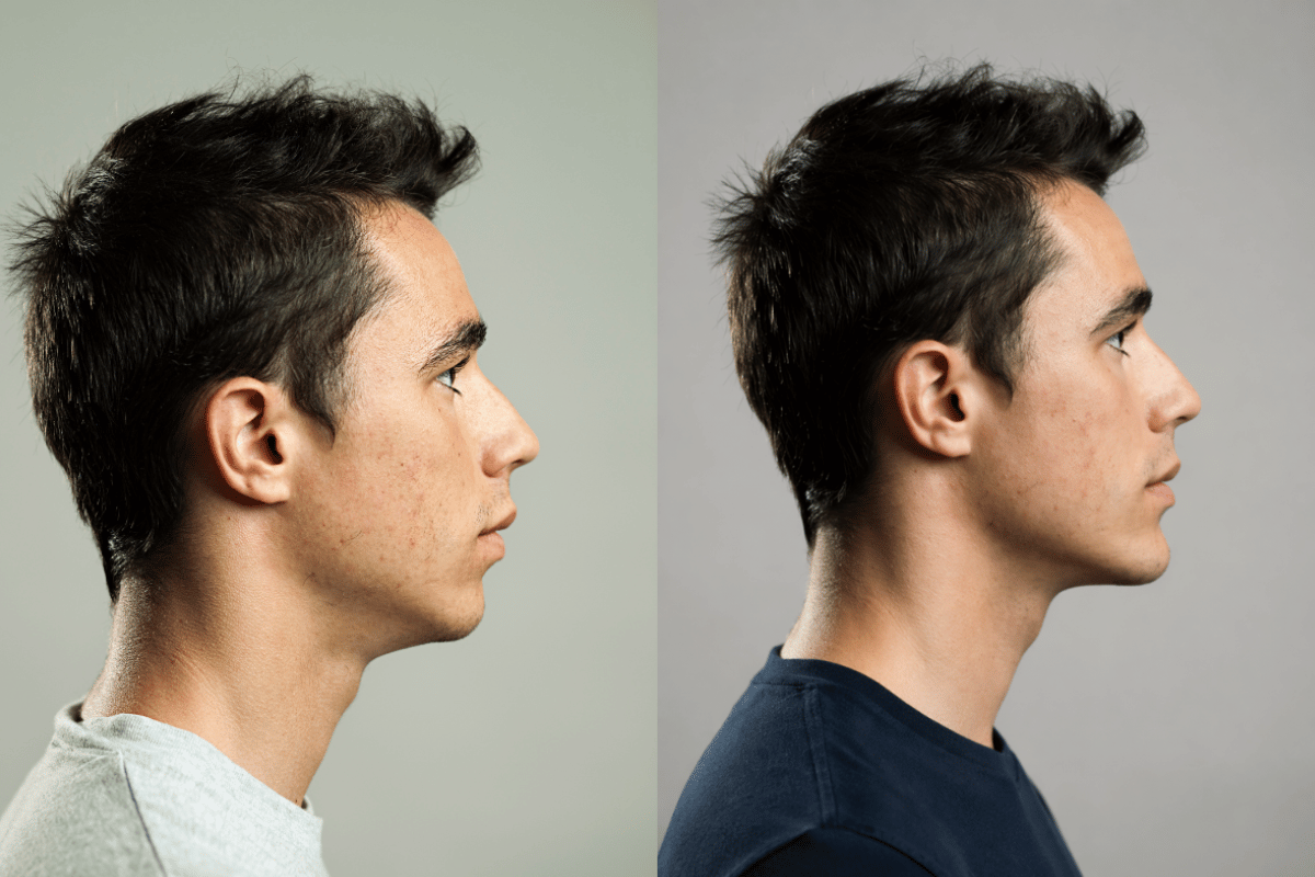 before and after chin filler for male patient showing jaw balance and proportions